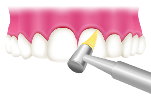 歯と歯の隙間清掃