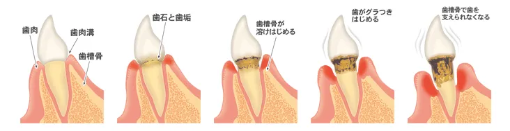 歯周病の進行
