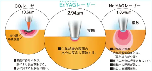 レーザー比較