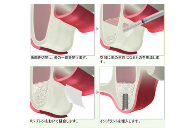 歯周組織の再生療法・骨造成を伴うインプラントも可能
