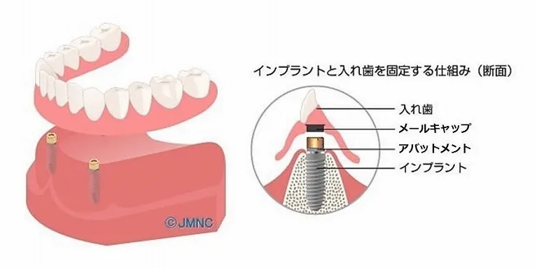 インプラントオーバーデンチャー