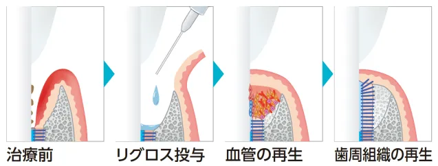 リグロスによる歯周組織の再生