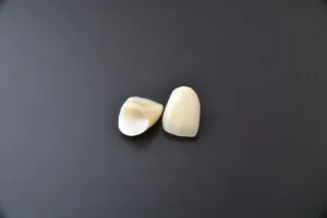 前歯のセラミック治療