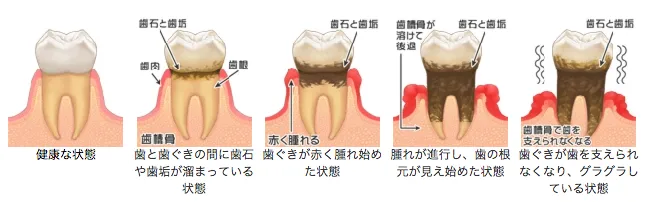 歯周病の進行