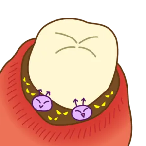 歯周ポケットは歯周病細菌の温床